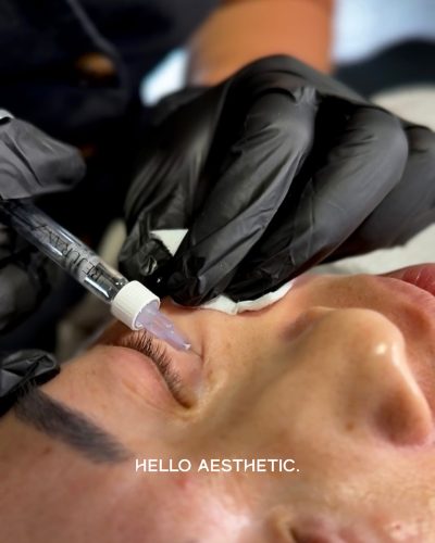 Client receiving injection of Rejuran under eye